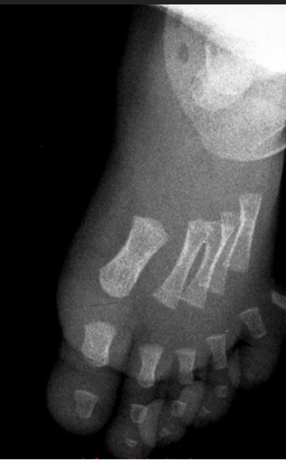 radiographie d'un pied de bébé