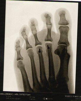 Radiographie d'un pied d'homme adulte